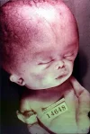 404px-Hydrocephalus-baby.webp