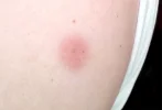 Zweitimpfung-BioNTech_Einstichstelle-nach-48Std_low.webp
